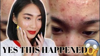 Acne Pinple Master Patch by COSRX